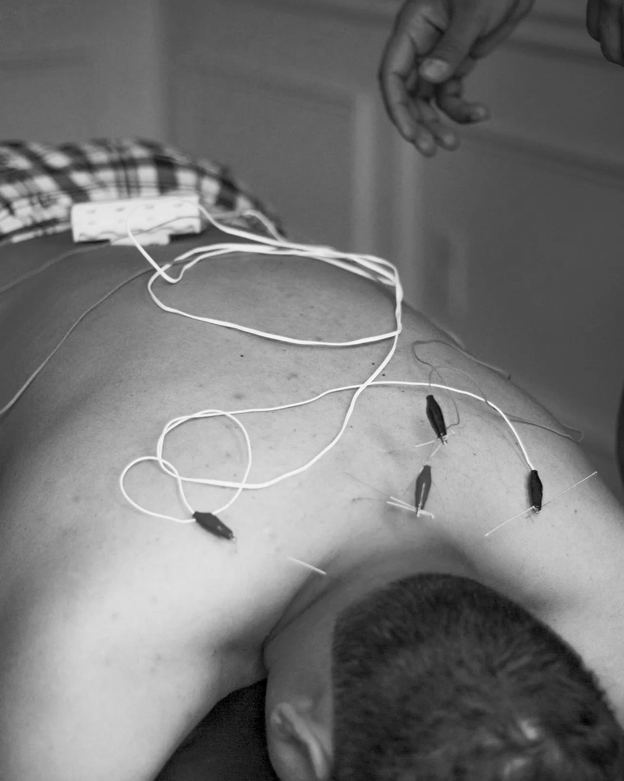 Gtaspine acupuncture 2